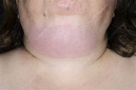 Cellulitis Of The Neck Stock Image C0150346 Science Photo Library