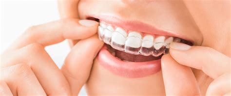 Invisalign is easier to care for because the device is removable, unlike traditional braces. After Invisalign: How Many Hours a Day Will I Need to Wear ...
