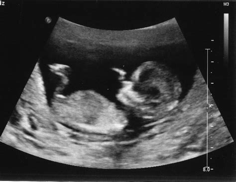 Your ultrasound tech will put some (cold) gel on your belly and glide a transducer over it with mild pressure. mooshkatoo: We're Having a BOY!!