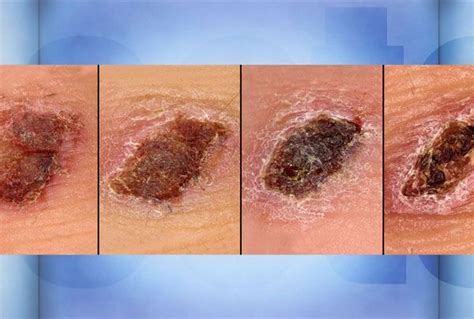 The Dangers Of Picking Scabs Scab Healing Makeup Life Hacks Skin Health