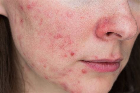 What Is Fungal Acne And How Do You Get Rid Of It