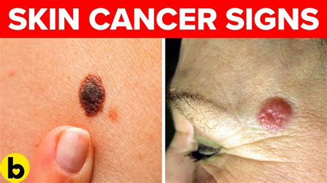 Early Skin Cancer Signs You Must Watch Out For Youtube