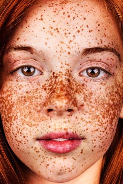 These Portraits Celebrate The Joy Of Having Freckles Freckles Girl Beautiful Freckles Freckles