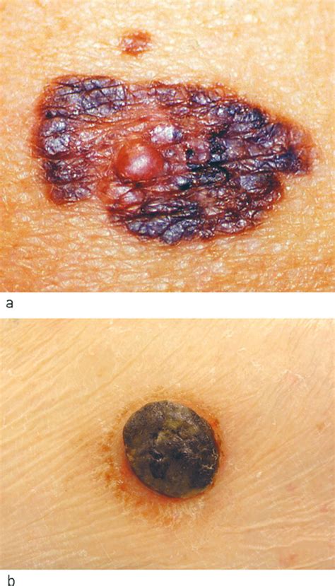 Malignant Melanoma Diagnosis Treatment And Follow Up In Norway