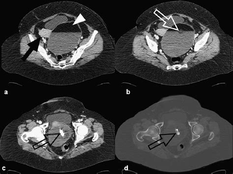 Mature And Immature Ovarian Teratomas Ct Us And Mr Imaging