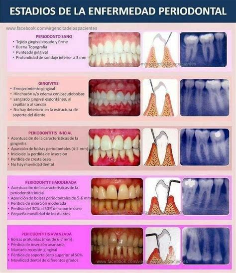Stages Of Periodontal Disease Odontología Higienista Dental Higiene