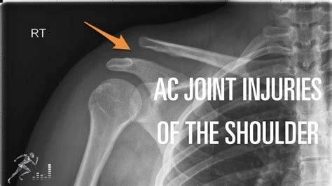 Acromioclavicular Ac Joint