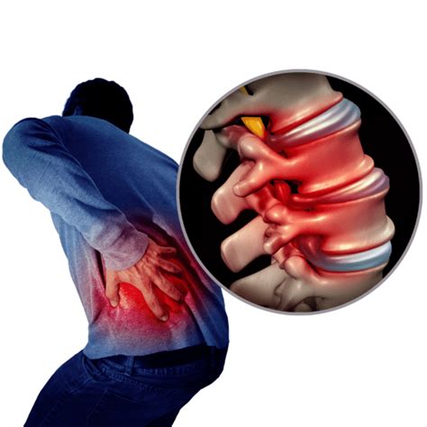 Bulging And Herniated Discs Explained Physical Health Care