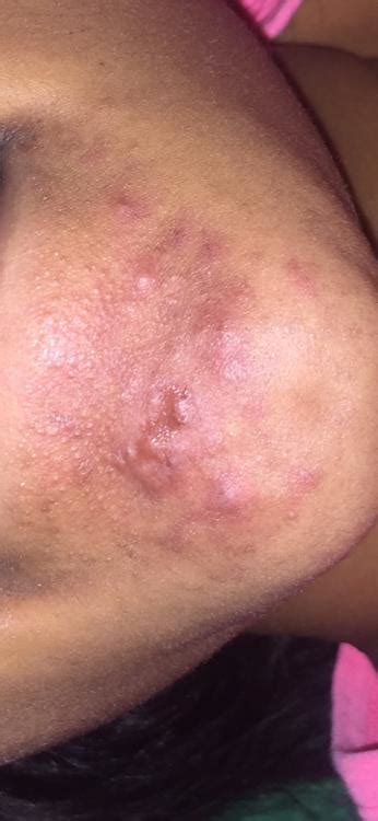 Acne Related Bumps That Wont Go Away General Acne Discussion
