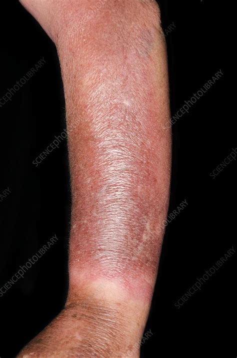 Cellulitis Of The Arm Stock Image C0168160 Science Photo Library