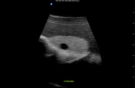 Thyroid Ultrasonography My Endo Consult