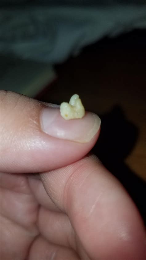 This Monster Tonsil Stone Was Bothering For Like A Month Rpopping