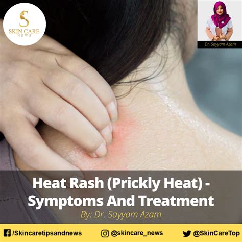 Heat Rash Prickly Heat Symptoms And Treatment