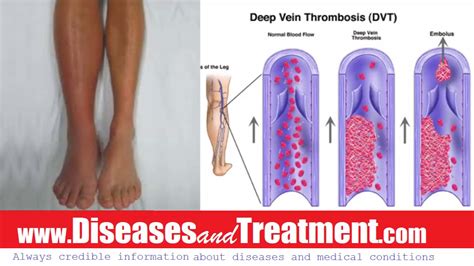 Deep Vein Thrombosis Dvt Causes Diagnosis Symptoms Treatment