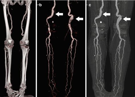Coronary ct angiography (ccta) is a noninvasive way to examine the walls of the coronary arteries, looking for hard and soft plaque. Upper and Lower Limb Imaging | Radiology Key
