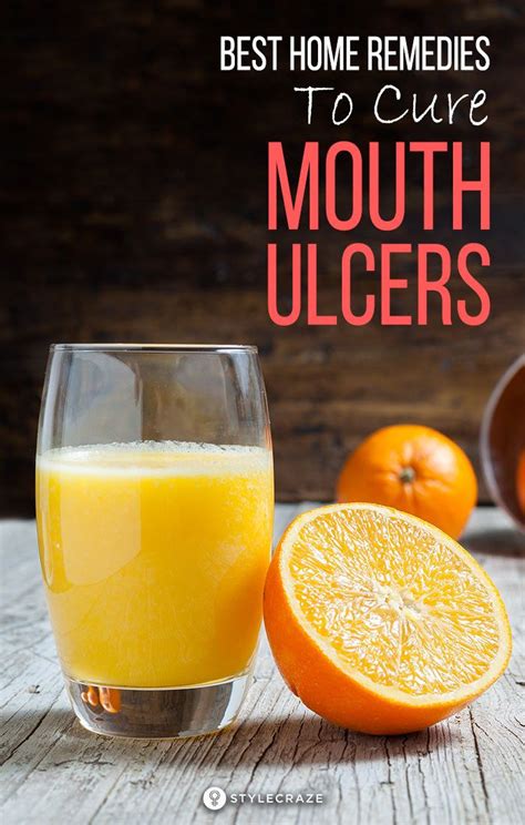Home Remedies For Mouth Ulcer 15 Natural Remedies To Try At Home In