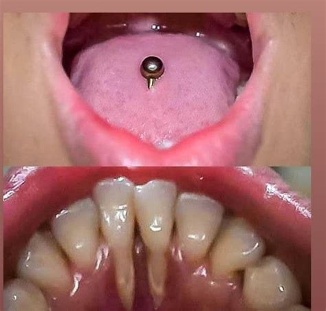 Consequences Of Tongue Piercing Medizzy