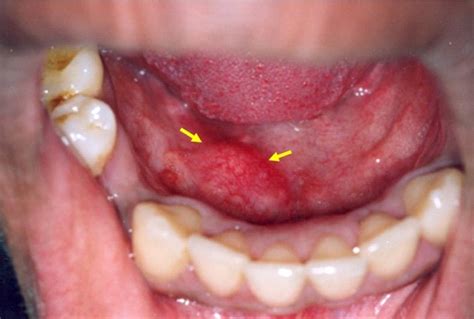 Bump On Tongue Can Be Caused By This Disease Vibonaci