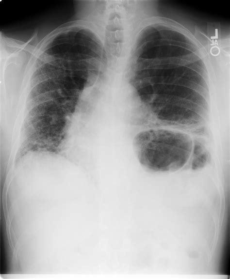 American Thoracic Society Nonspecific Interstitial Pneumonitis Or