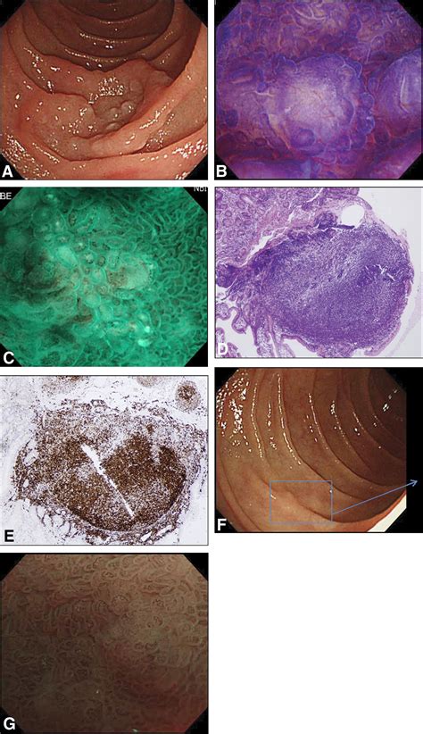 Case Series Of Duodenal Follicular Lymphoma Observed By Magnified Endoscopy With Narrow Band