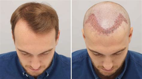 Receding Hairline Causes Symptoms And Treatment Rephair