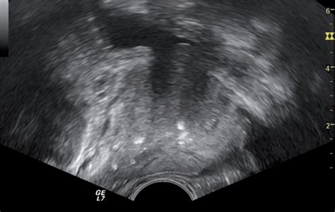 Scielo Brasil Ultrasound Detection Of Prostatic Calculi As A