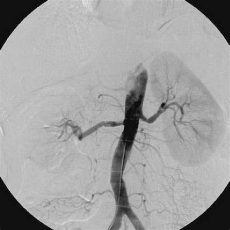Right Renal Angiogram Showing Irregular Beaded Appearance Of The