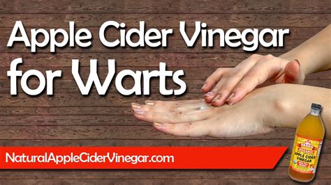 How To Get Rid Of Warts Naturally With Apple Cider Vinegar Youtube