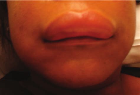 swelling upper lip angioedema