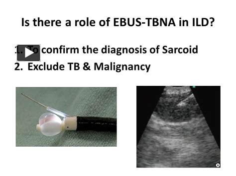 Ppt Is There A Role Of Ebus Tbna In Ild Part 7 Dr Sheetu Singh