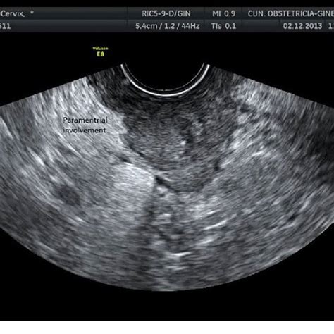 Transvaginal Ultrasound Cancer My Xxx Hot Girl
