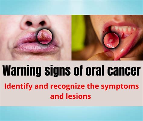 Warning Signs Of Oral Cancer Identify And Recognize The Symptoms And