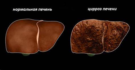 Цирроз печени у алкоголиков — неизбежный диагноз Картинка - Цирроз печени у алкоголиков — неизбежный диагноз