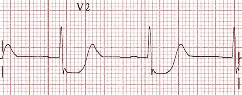 Posterior Wall Myocardial Infarction Is Best Identified In Which Leads