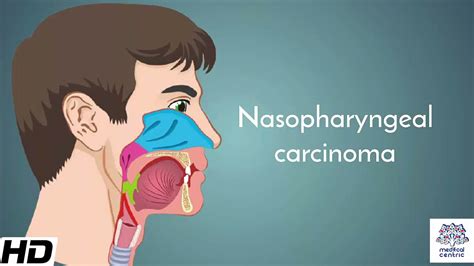 Nasopharyngeal Carcinoma Causes Signs And Symptoms Diagnosis And