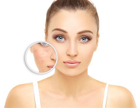 3 Acne Solutions That Work Specialists In Dermatology Pllc Dermatologists