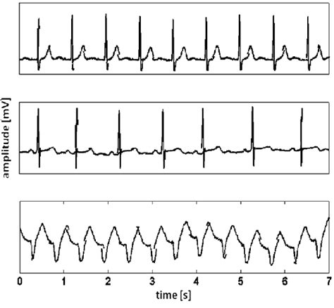 Different Types Of Ecg Signals Normal Top Arrhythmia Middle And