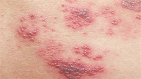 The Stages Of Shingles