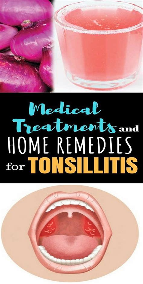 Medical Treatments And Home Remedies For Tonsillitis Medical