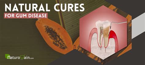 Maybe you would like to learn more about one of these? 9 Effective Natural Cures for Gum Disease that Work ...