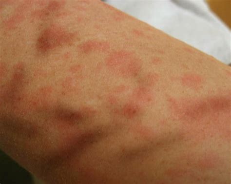 Skin Rash 68 Pictures Causes And Treatments Common Sk