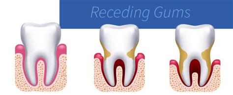 What Causes Receding Gums