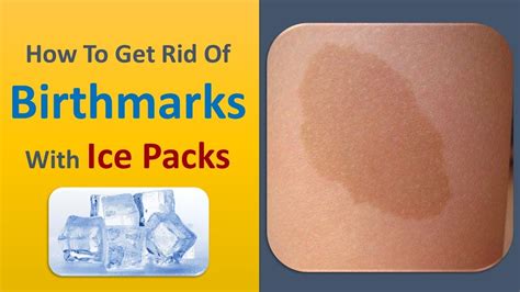 How To Get Rid Of Birthmarks With Ice Packs Youtube