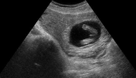 13 Week Ultrasound Gender
