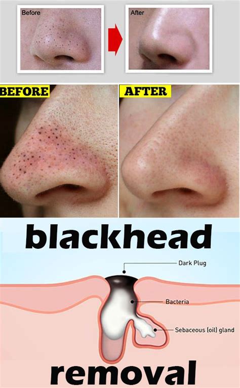 How To Get Rid Of Blackheads On Private Area Howtoremvo
