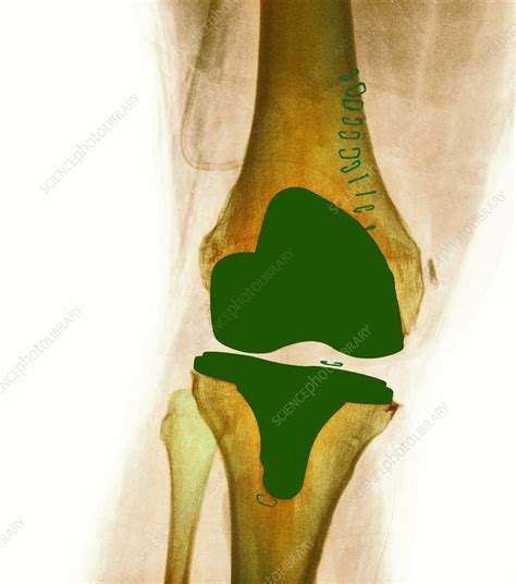 Knee Joint Prosthesis X Ray Stock Image M6000328 Science Photo