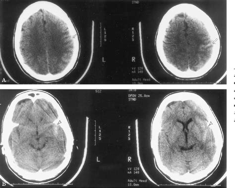 Figure 1 From Non Aneurysmal Primary Subarachnoid Hemorrhage In