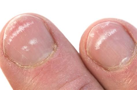 White Spots On Nails Trauma