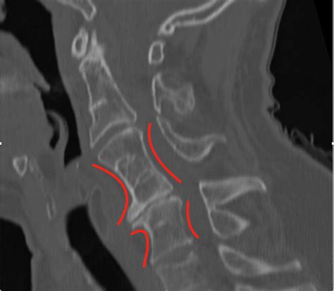 Ct Of Cervical Spine A Mid Sagittal Reformatted Ct Scan Of The