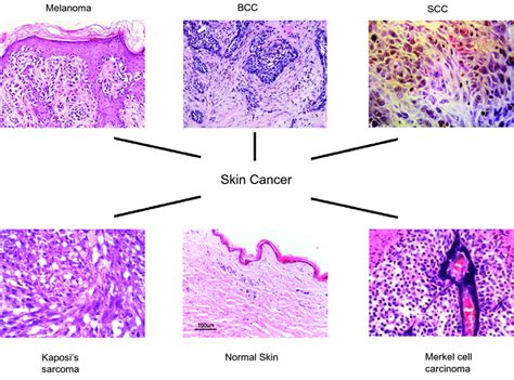 The Characteristic Histology Of Melanoma Bcc Scc And Some Rare Skin